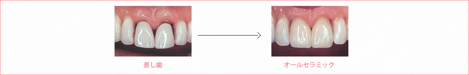 オールセラミック