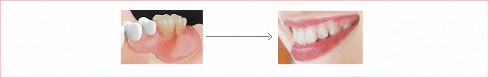 床を延長したバネ