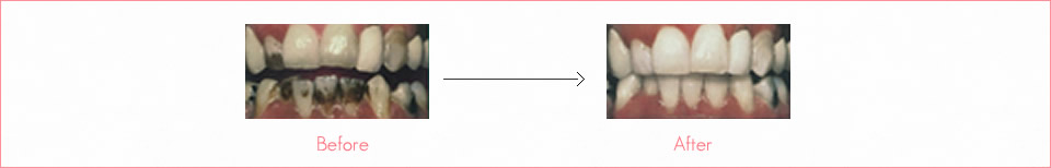 喫煙によるもの