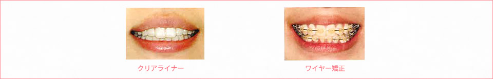 ワイヤー矯正
